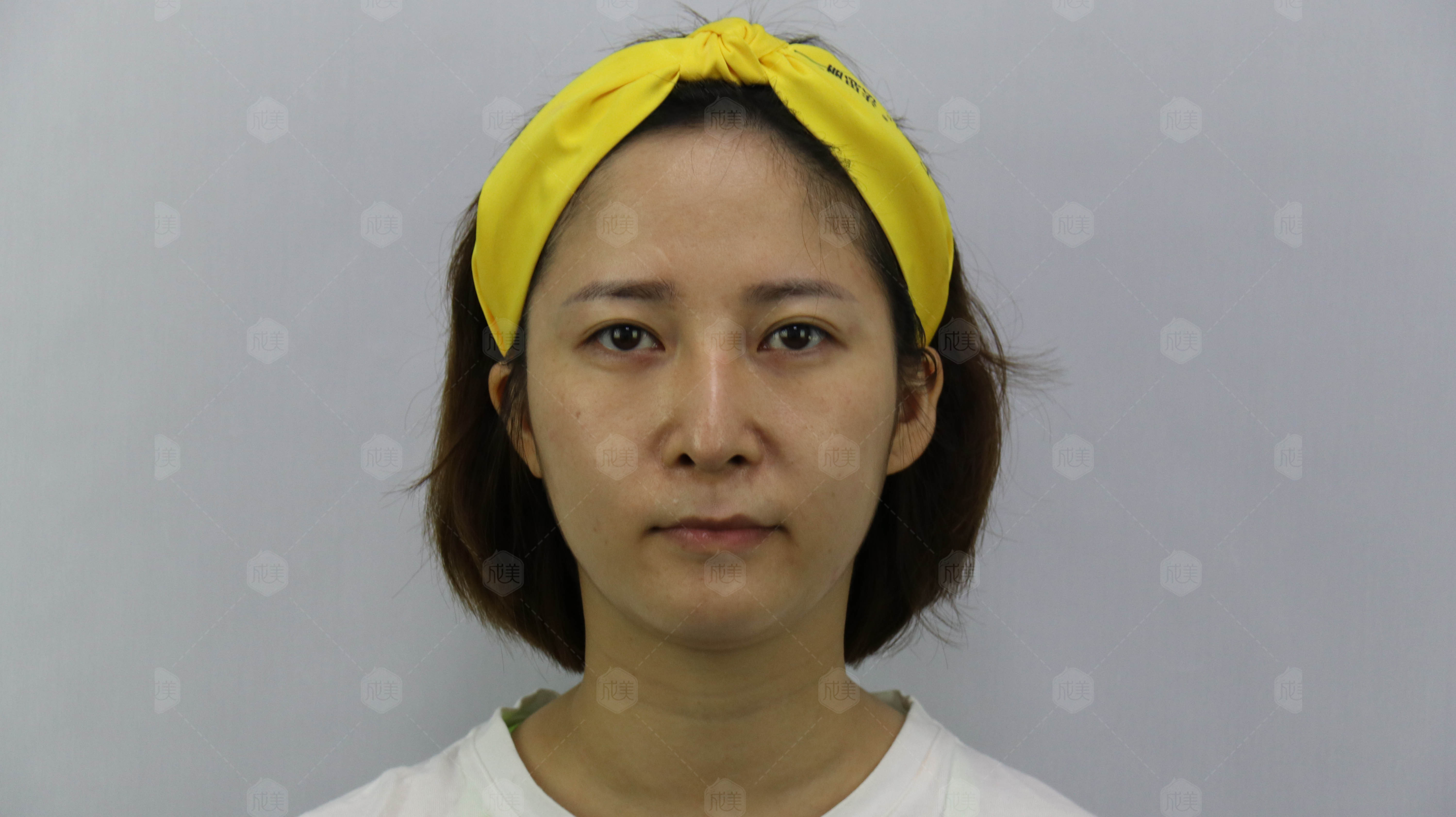填充面部脂肪保持多久_脂肪面部填充保持多久_填充面部脂肪保持几年