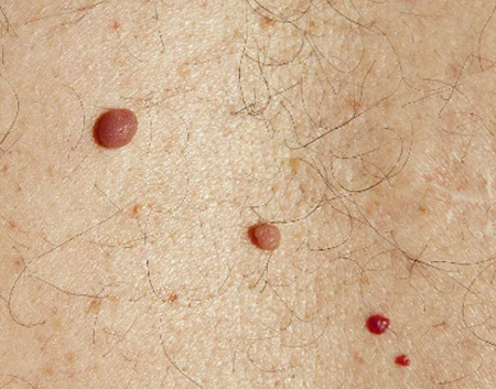 身上"红痣",不用怕!