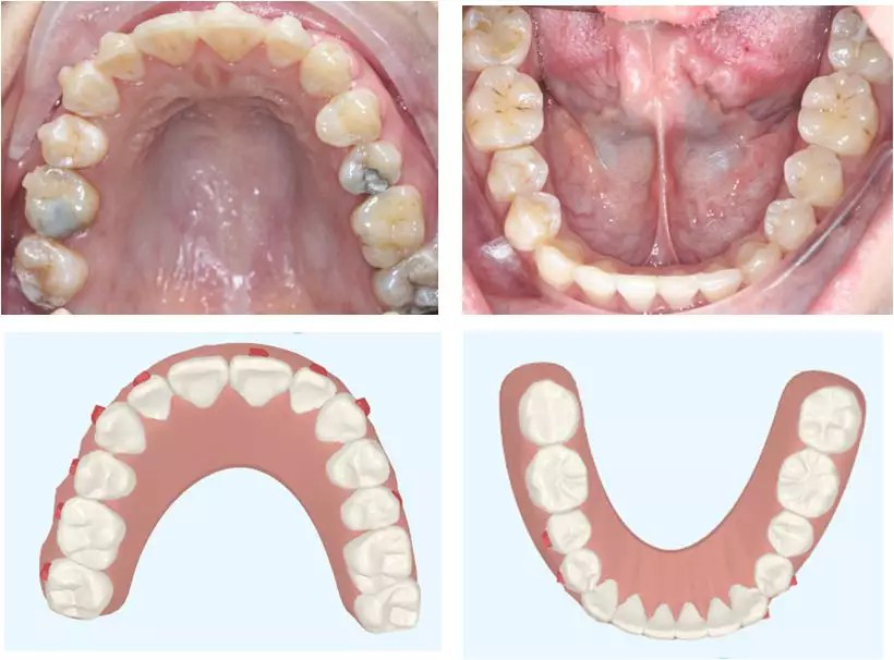 隐形矫治解决半侧反颌伴下颌偏斜一例