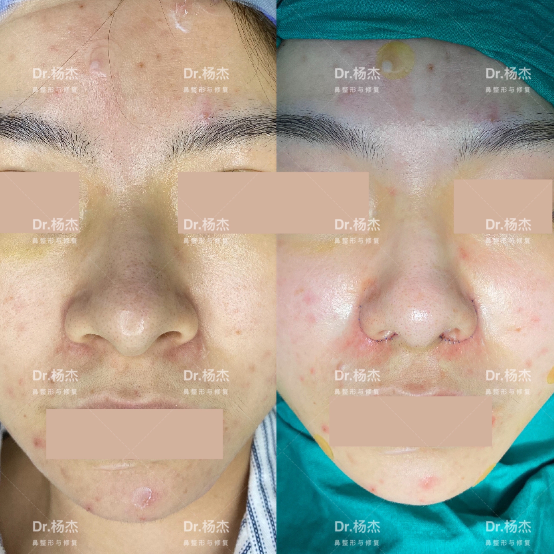 内外联合鼻翼缩小鼻小柱缩短