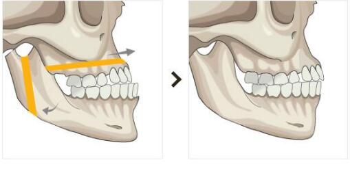 被称为"丑女大翻身"的双鄂手术,你适合做吗?