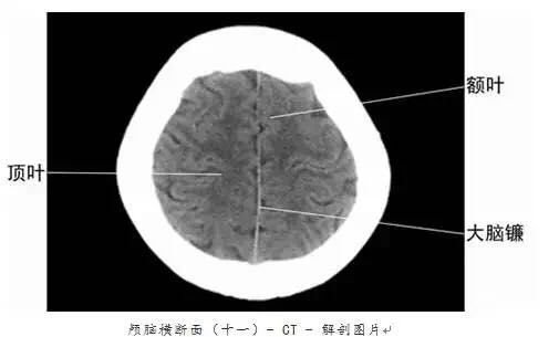 颅脑ct图谱