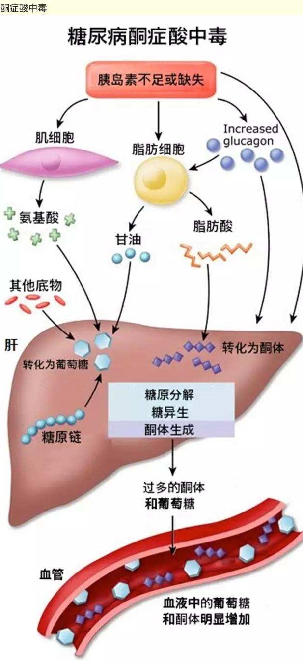 尿中有酮体就是酮症酸中毒吗?