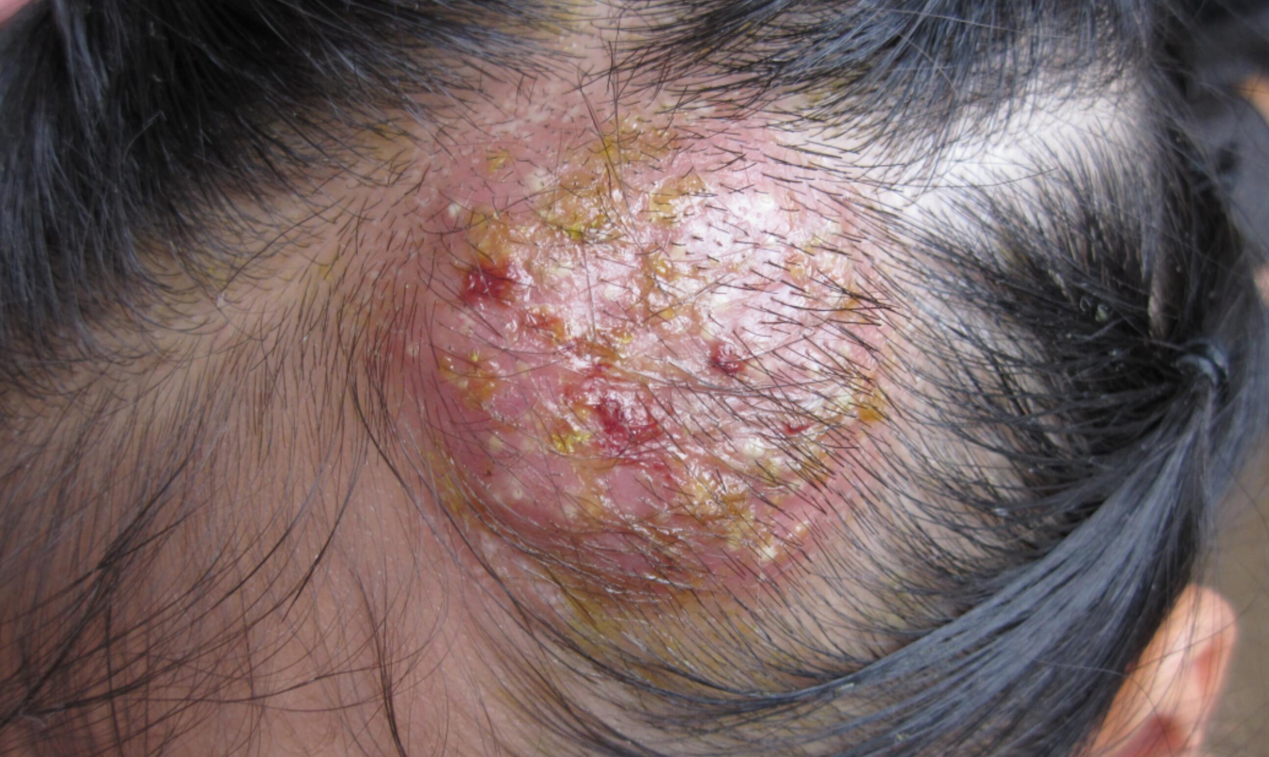 必知脱发那点事儿