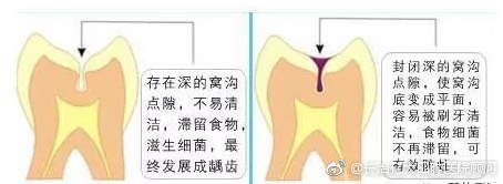 3,六齡齒齲壞率高