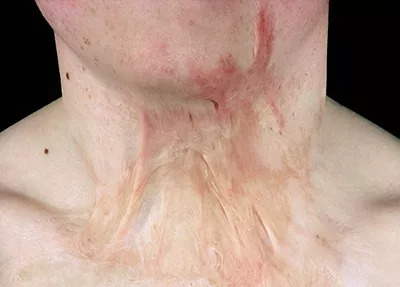 颈部疤痕发生挛缩有多严重