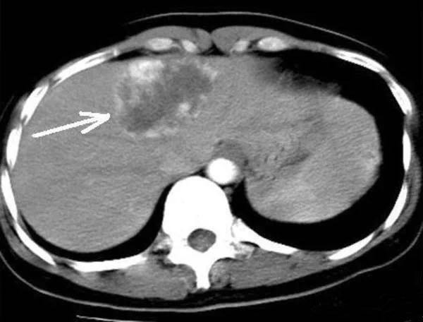 肝海绵状血管瘤