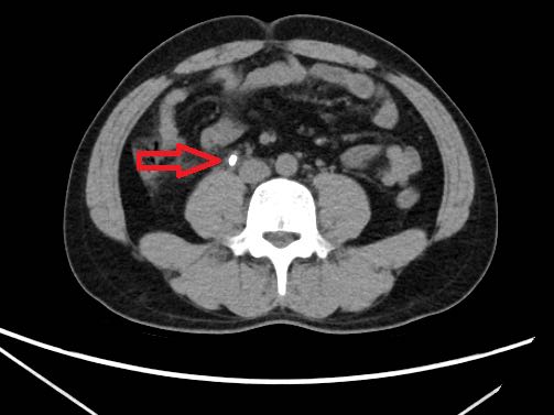 输尿管结石影像图片图片