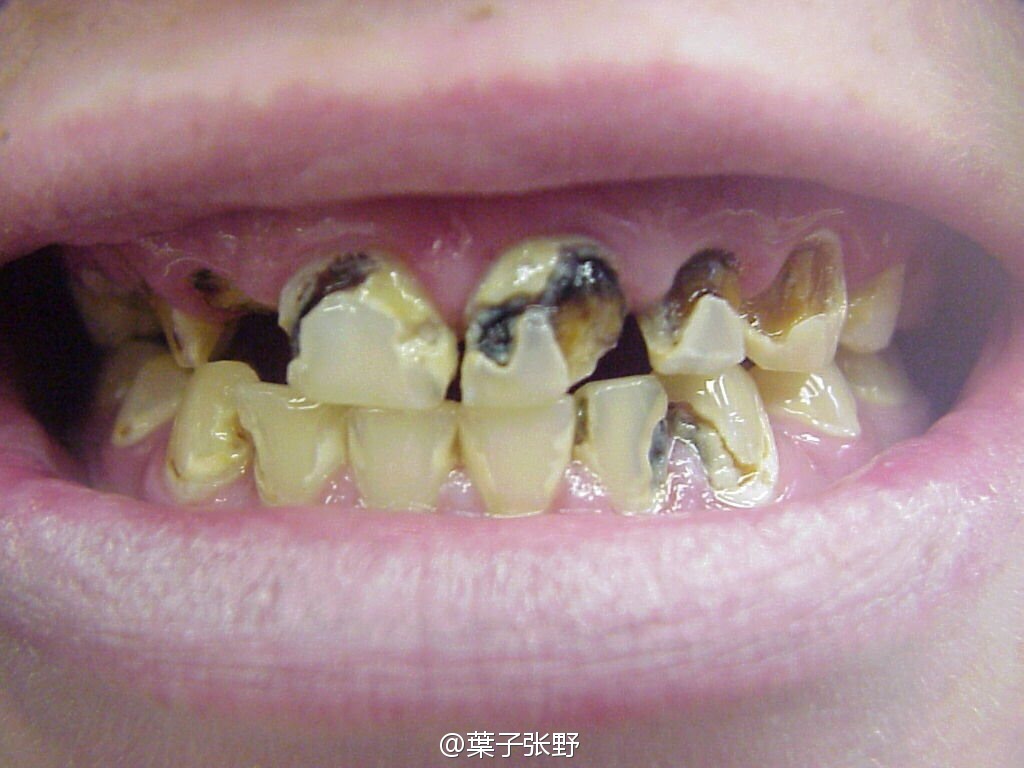 冰毒牙,四环素牙和牙齿色素的区别