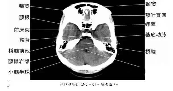 颅脑ct与你分享!让你了解颅内解剖