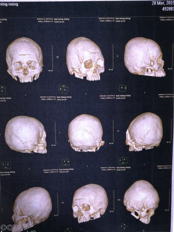 1,顱骨及上頜骨多發骨折並顱內積氣;2,右額部急性硬膜外血腫;右額顳頂