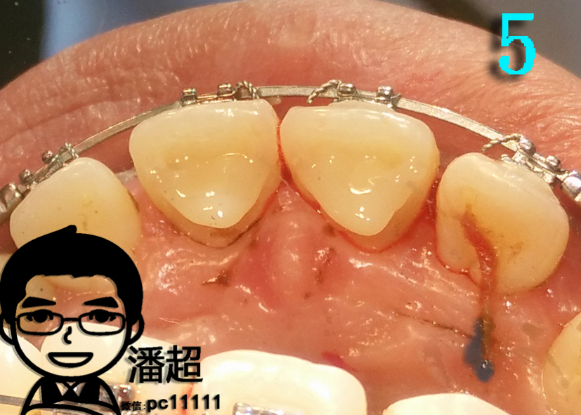 深覆合是啥?需不需矫正,附固定树脂平导制作过程