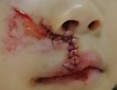 宝宝脸上的伤口一定要美容缝合!