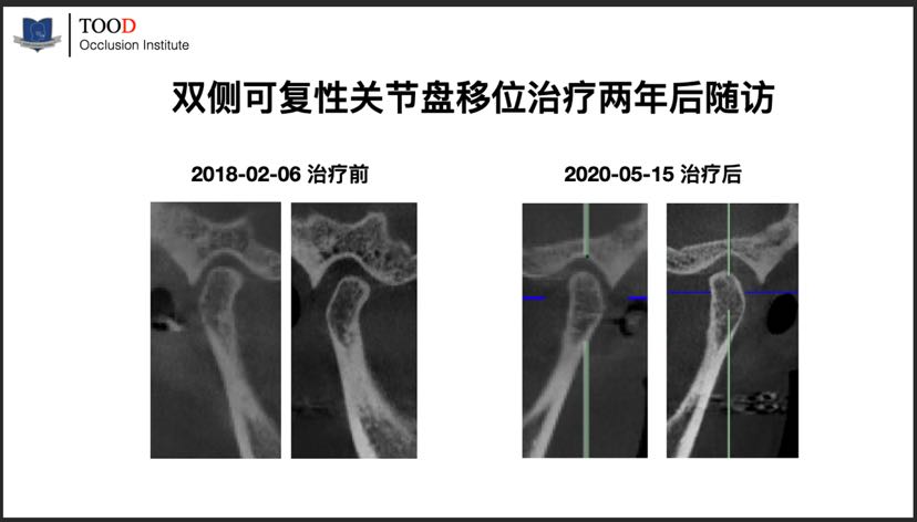 掉下巴及顳下頜關節彈響要早治療