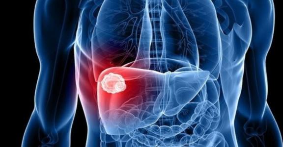 大三阳肝功能和b超正常病毒含量高肋骨有点疼需要抗病毒吗