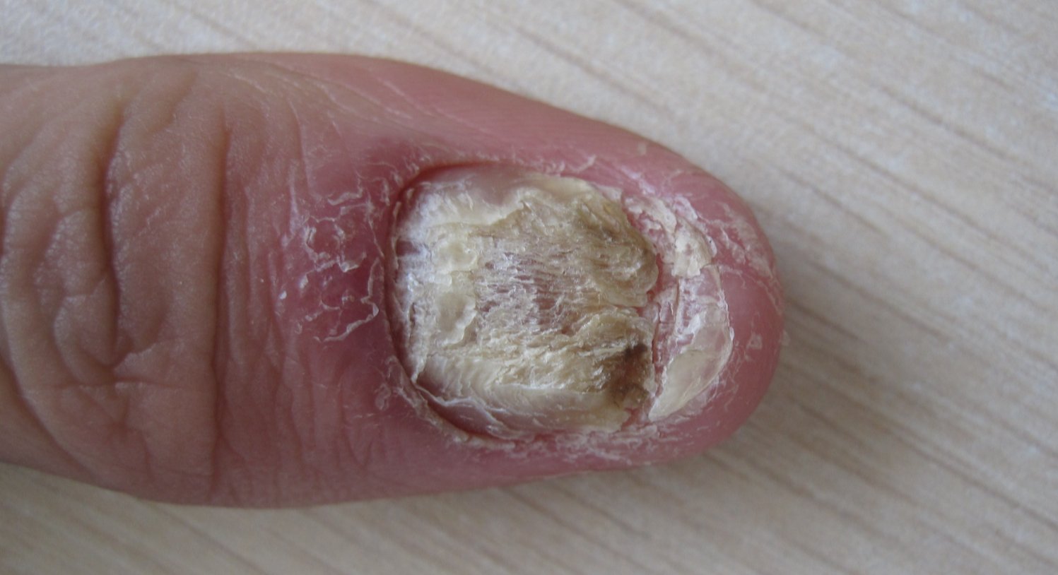指甲银屑病图片 初期图片