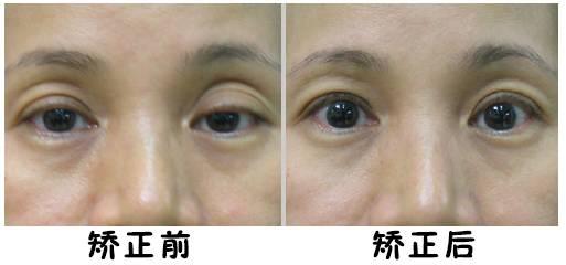 做完上睑下垂矫正,有些人的眼睛为何会闭合不全?