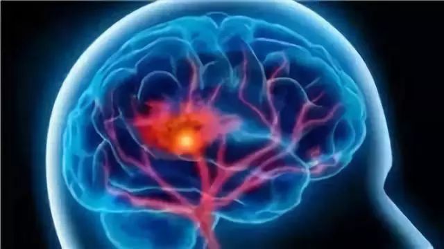 蛛网膜下腔出血,严重神经功能缺失?卒中后癫痫的危险远不止这些