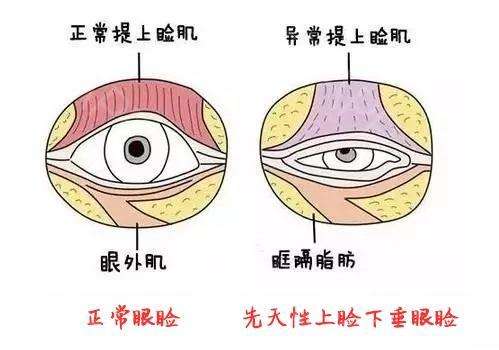 上睑提肌和双眼皮手术的区别在哪里?