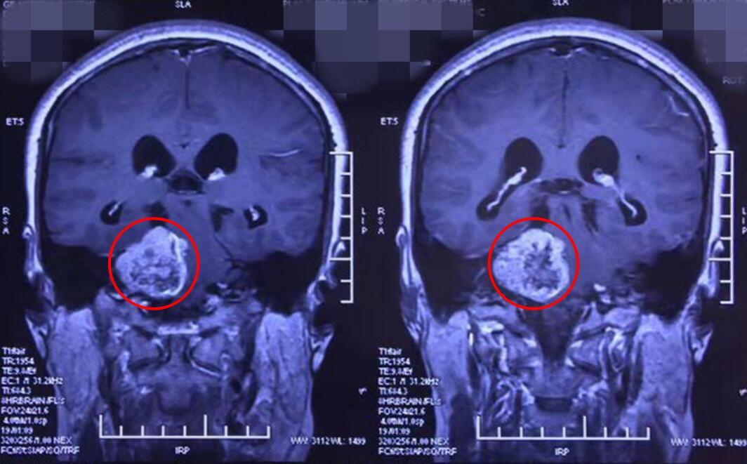 电话听不清,单侧耳听力下降,应特别留意听神经瘤!