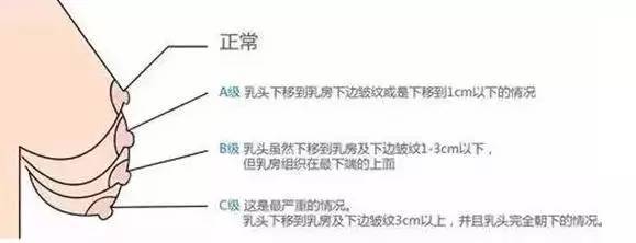 一,乳房下垂矫正术的优点