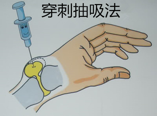 手腕上的肿块究竟该如何处理!