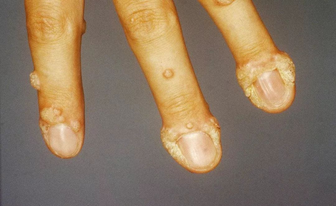 这些皮肤上长的"肉疙瘩",你知道是啥吗?