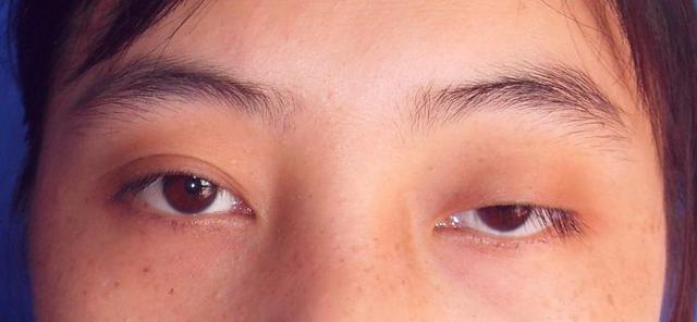 神经源性,肌源性及机械性等四种,其中肌源性者以重症肌无力引起者多见