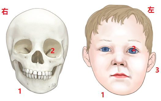 一侧斜颈,可导致对侧斜头畸形,对侧耳位前移,对侧眼眶变大,对侧面部