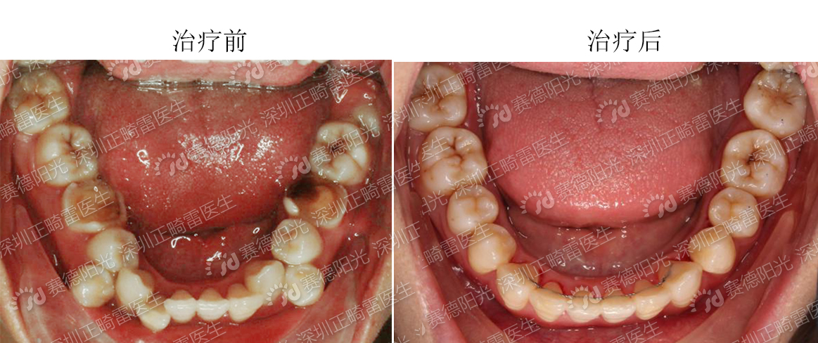 缺牙处的牙槽骨会继续生长充满拔牙间隙,矫正时拔牙处左右两边的牙齿