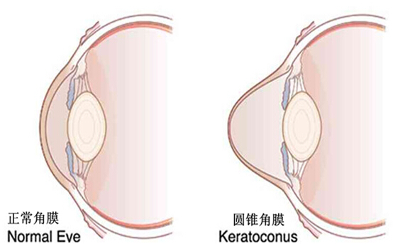 为什么你会患上圆锥角膜呢