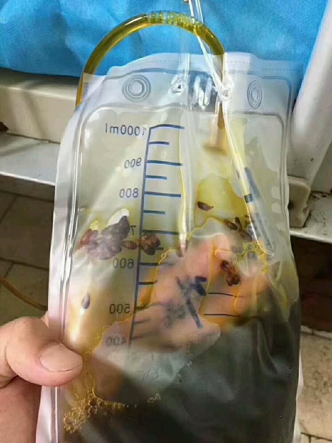 胆囊结石合并肝吸虫病应该先驱虫还是先手术