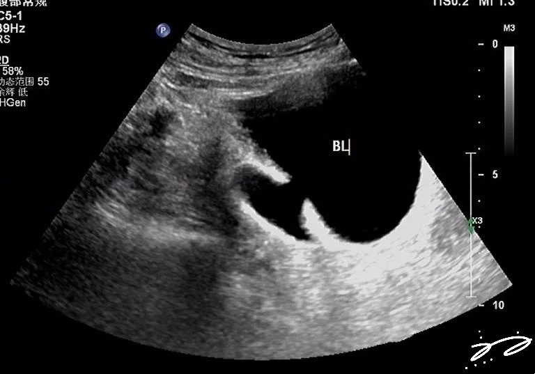 膀胱憩室与超声诊断