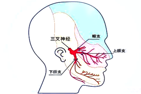 牙痛还是三叉神经痛