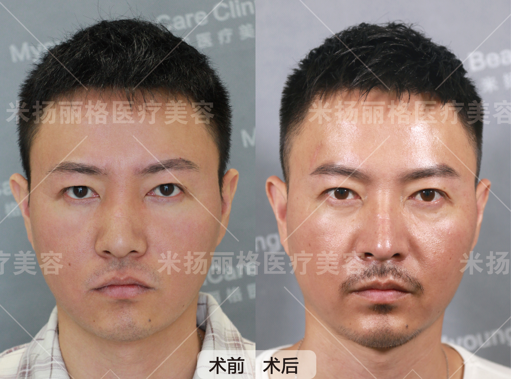 隆鼻恢复期到底需要多长时间