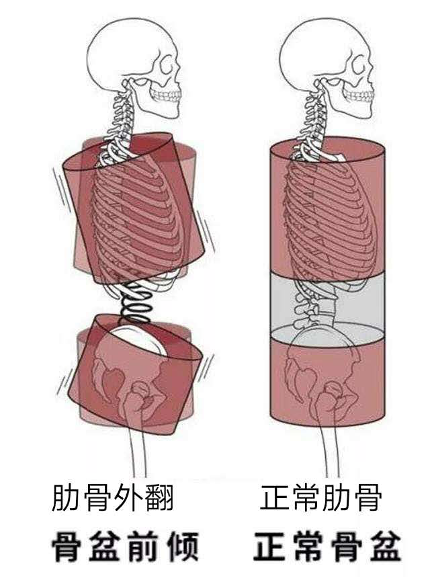 使腰椎前曲和胸椎后曲角度变大,从而使肋骨下部向前方突出