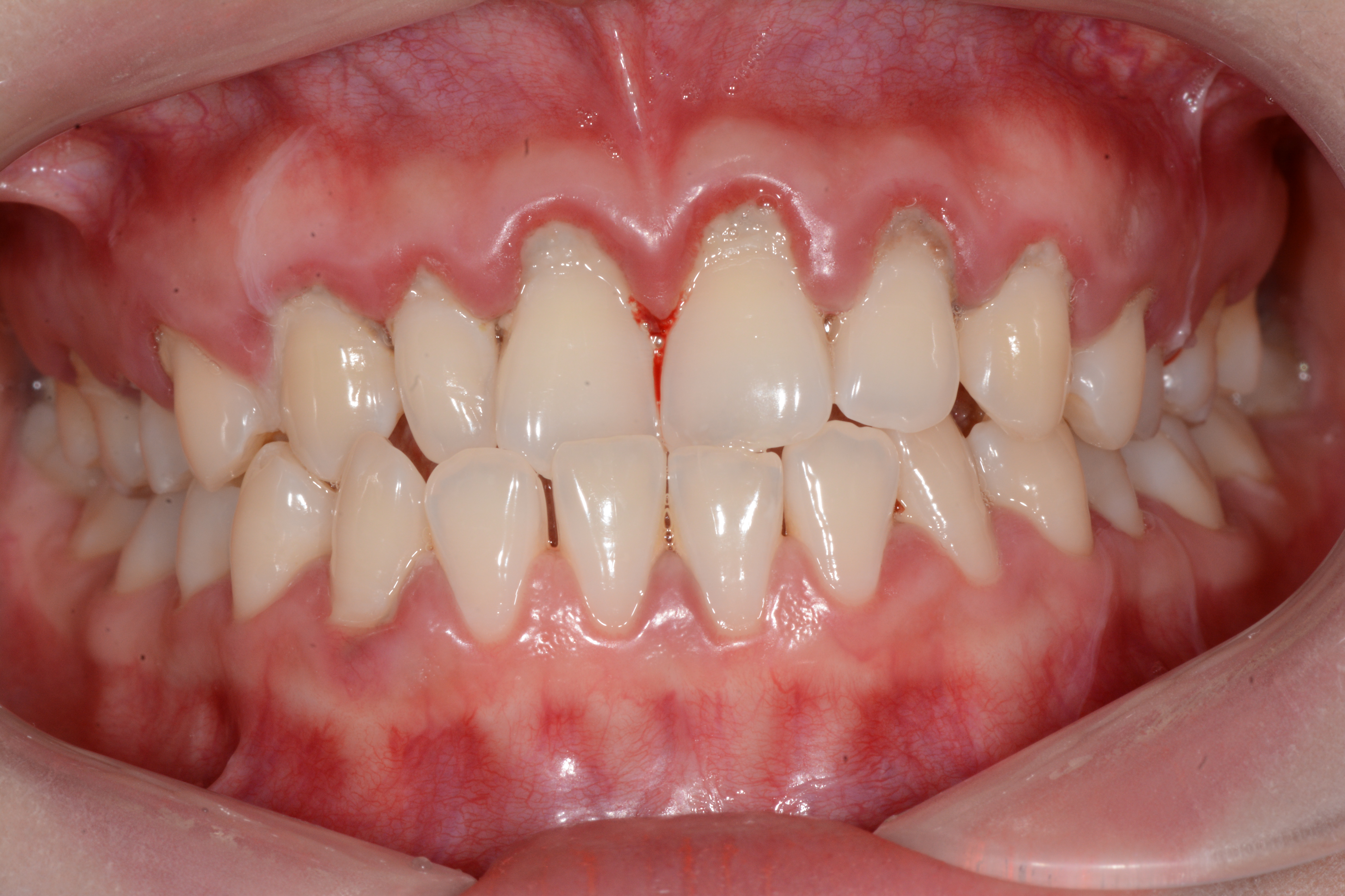 牙齿表面的牙结石跟色素是如何形成呢?