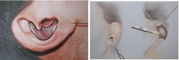 耳软骨隆鼻和肋软骨隆鼻有什么区别?