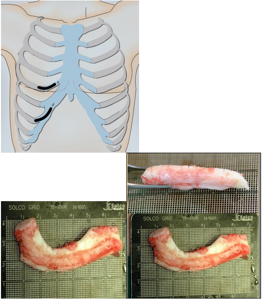 什么是全肋隆鼻?-刘波主治医师-爱问医生