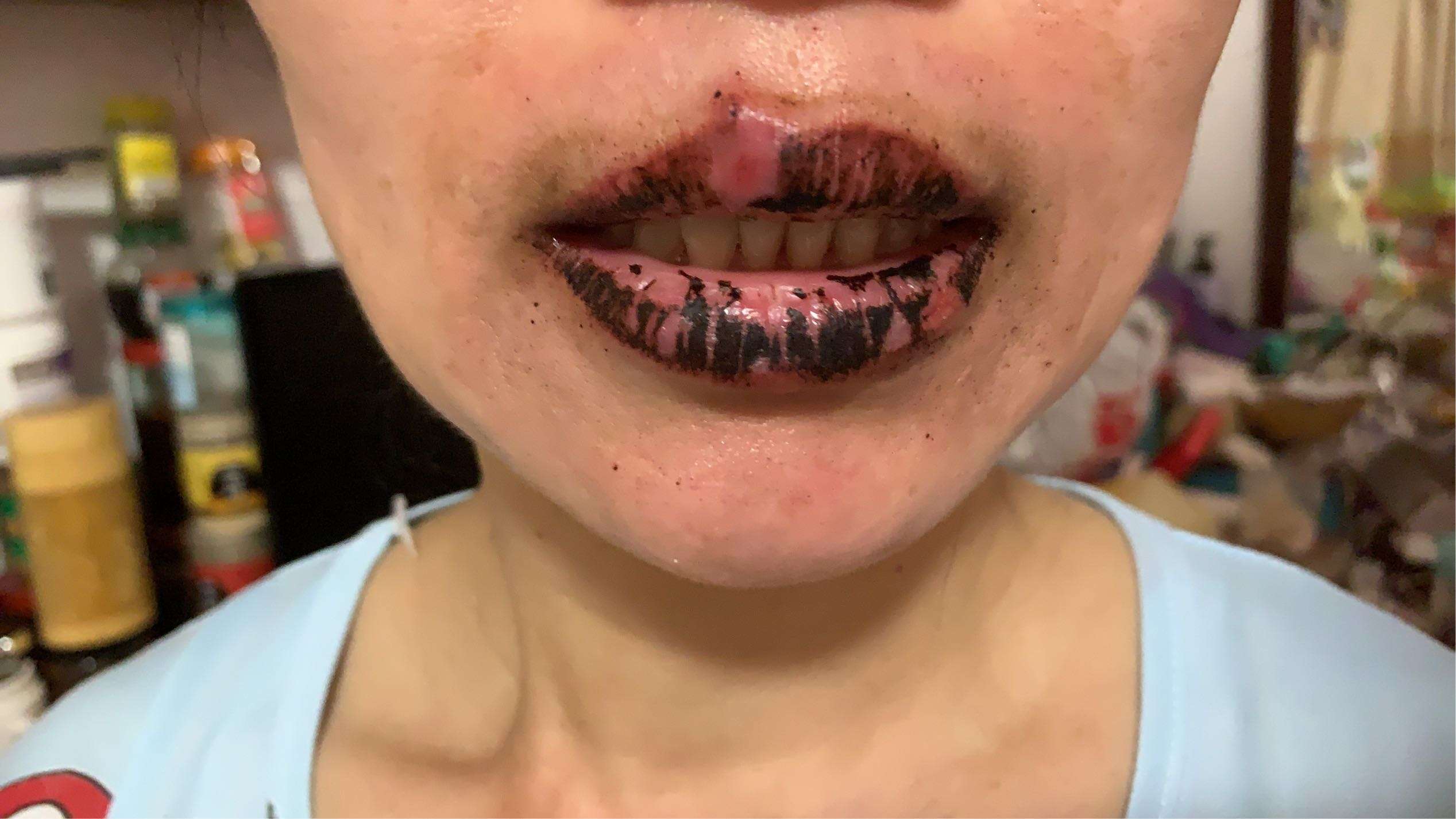 高锰酸钾消毒片导致嘴唇发黑