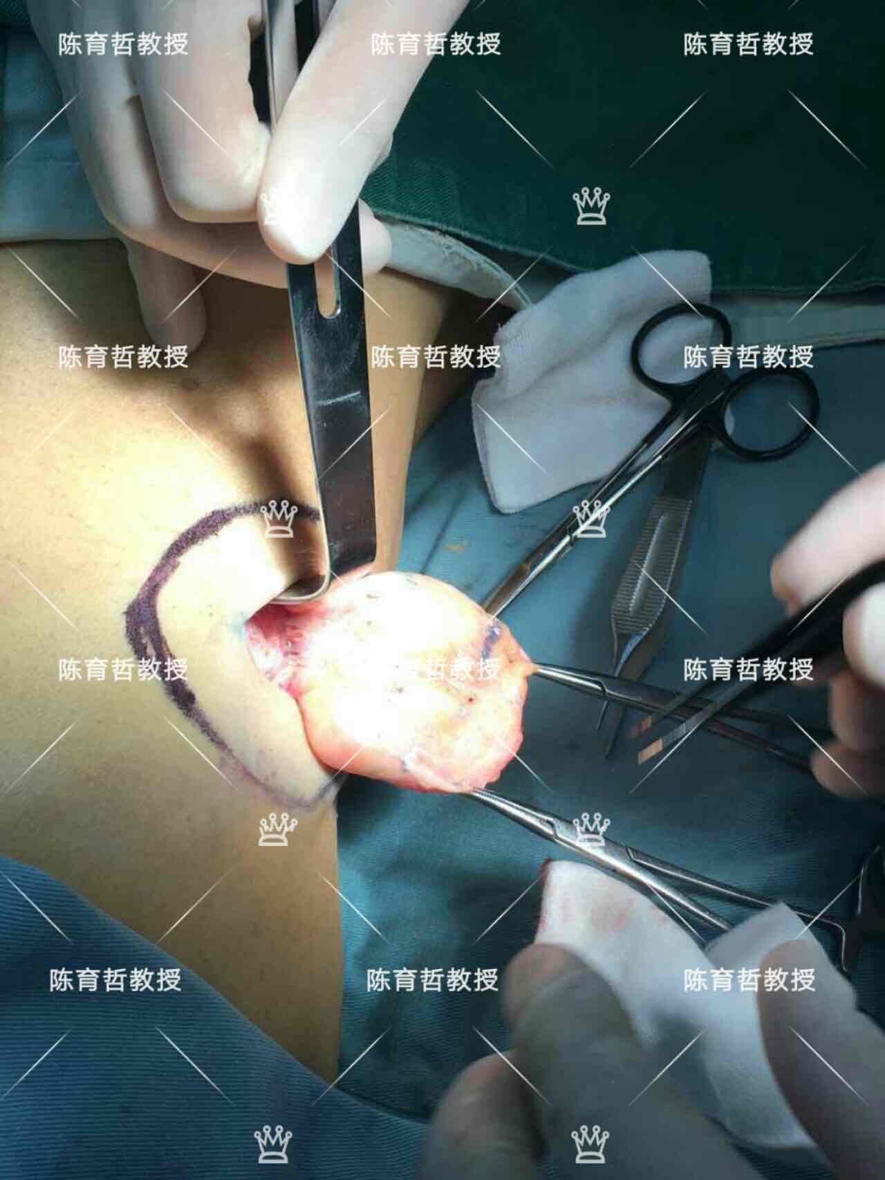 皮脂腺瘤手术图片