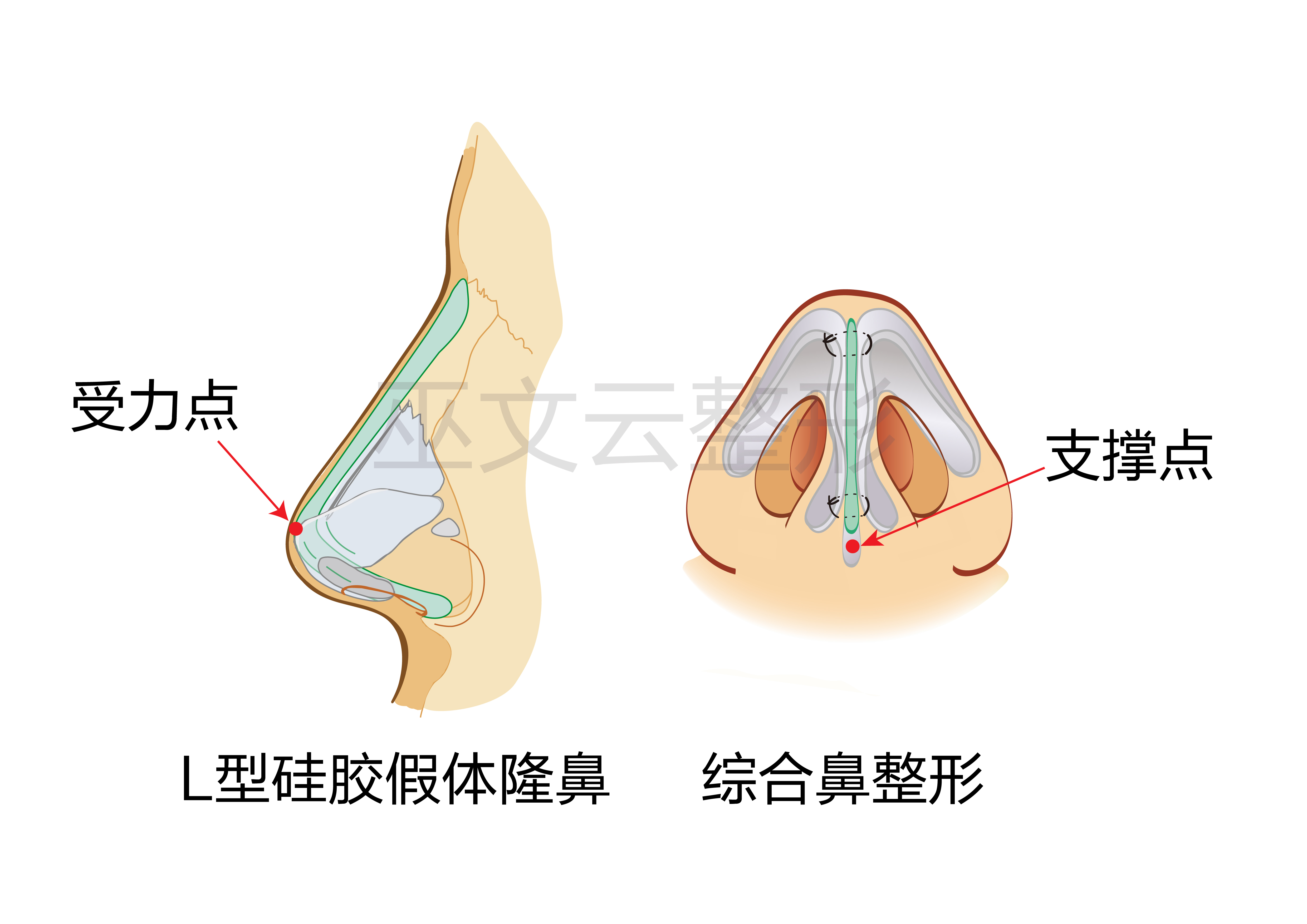 单纯柳叶假体不垫鼻尖图片