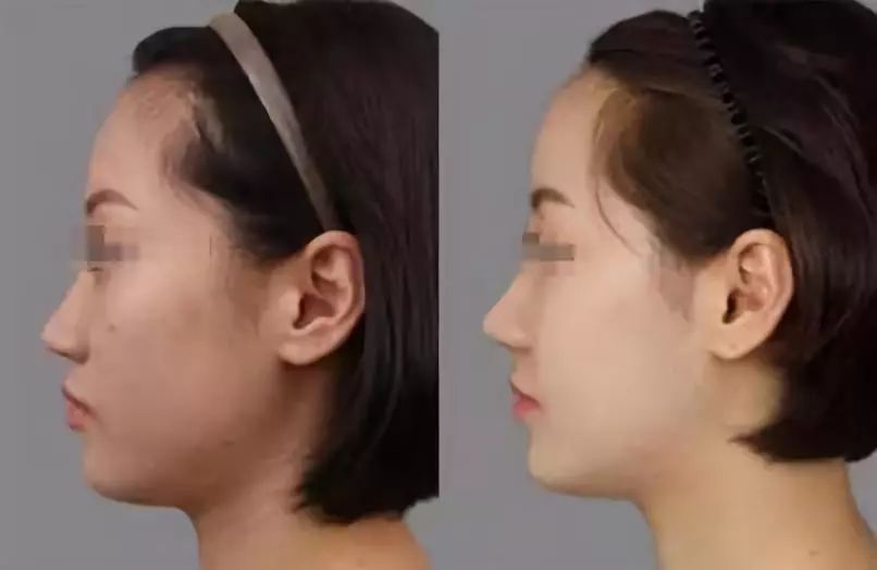 艺术骨雕隆鼻就是鼻你美