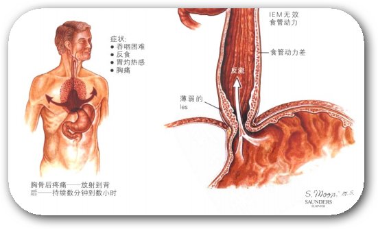 奥迪括约肌痉挛图片