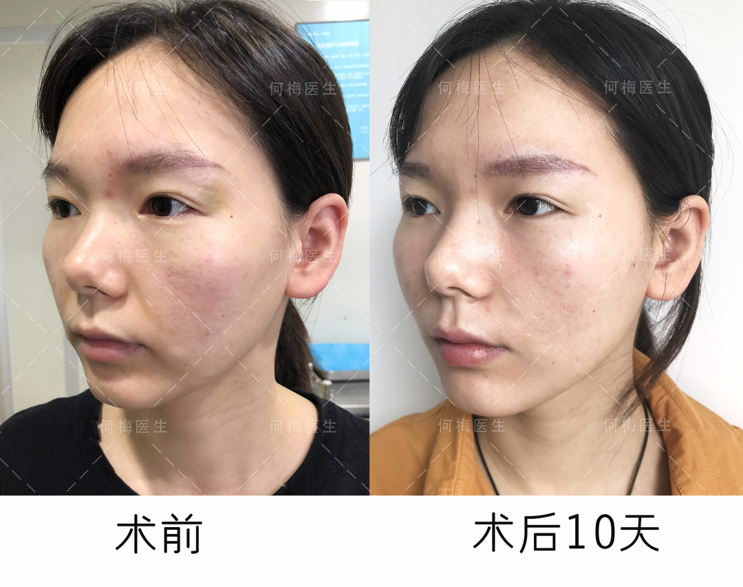 求美者年龄较轻,下面部却一直备受法令纹,口角囊袋,面颊松弛下垂等