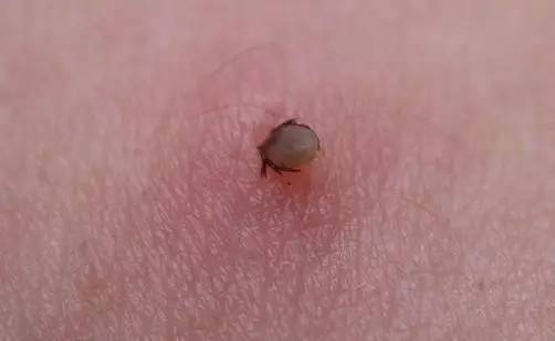 蜱虫可夺命,被它咬了该怎么办?