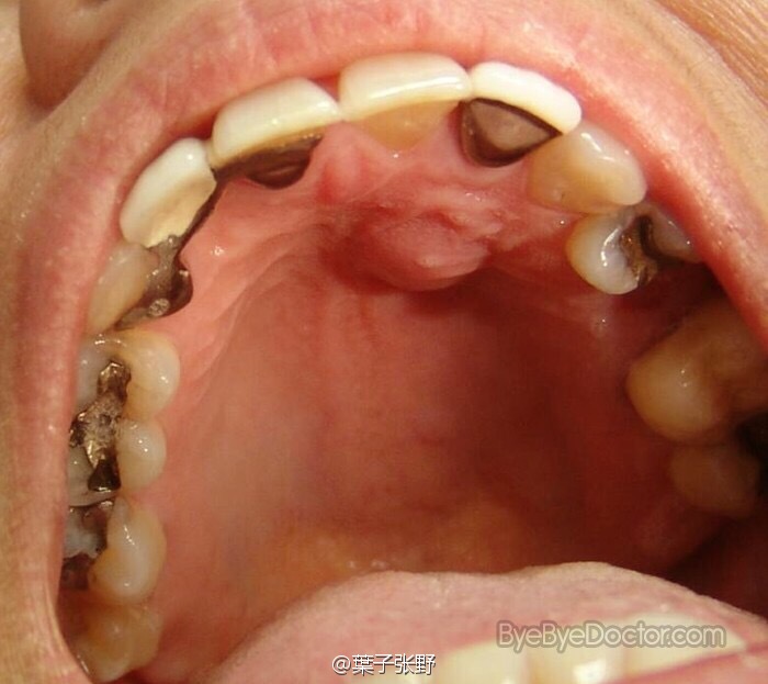 牙神经发炎,坏死,化脓,然后就从牙根方向影响牙槽骨