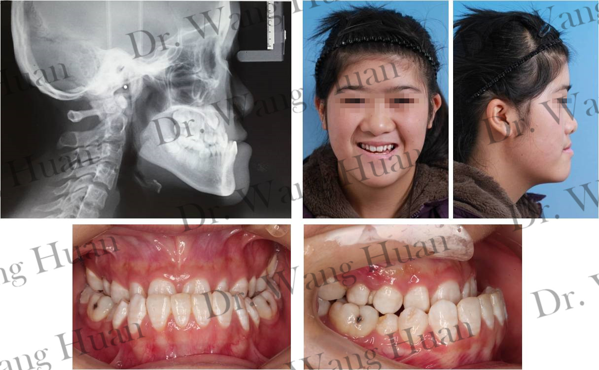 病例7:另外,在导萌阻生牙齿的过程中还会出现一类极少的情况,那就是
