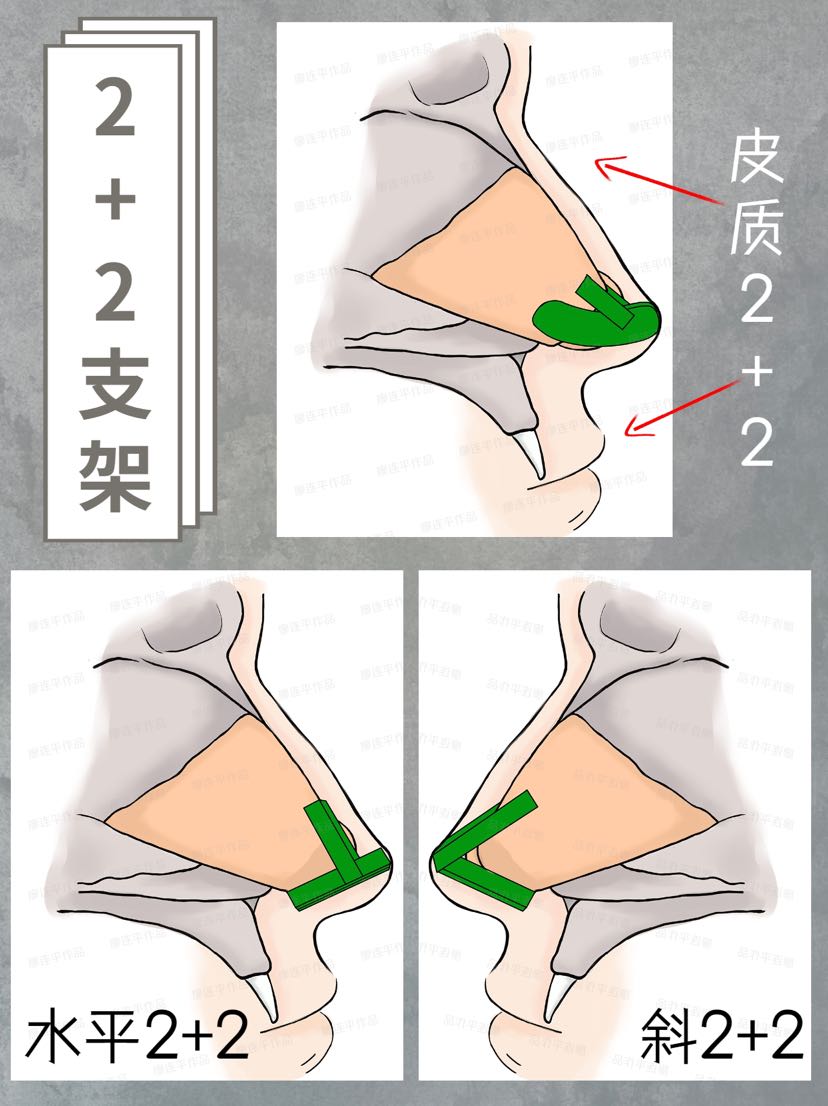 隆鼻功课篇:鼻支架最全解析!