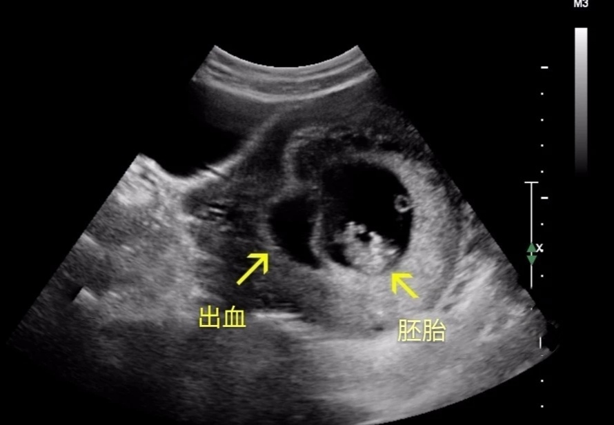 B超发现宫腔积血 是要流产了吗 周玲副主任医师 爱问医生